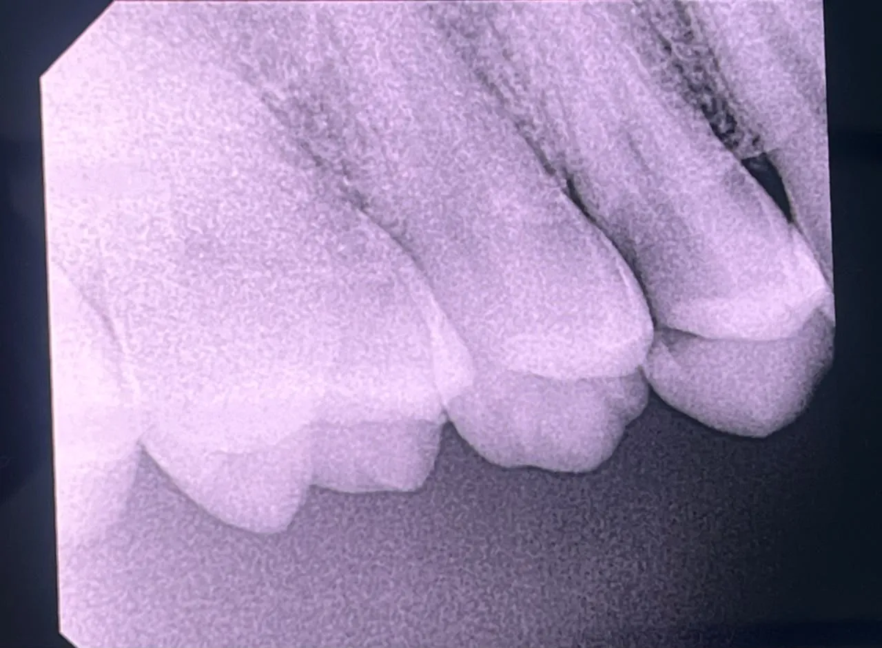 Intraoral radiograph showing decay reaching the pulp chamber of an upper molar