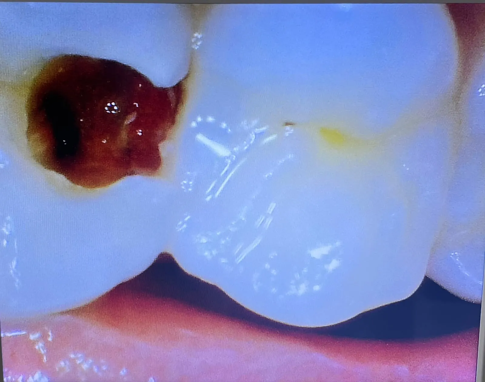 Magnified intraoral camera image of a deep carious lesion on a molar