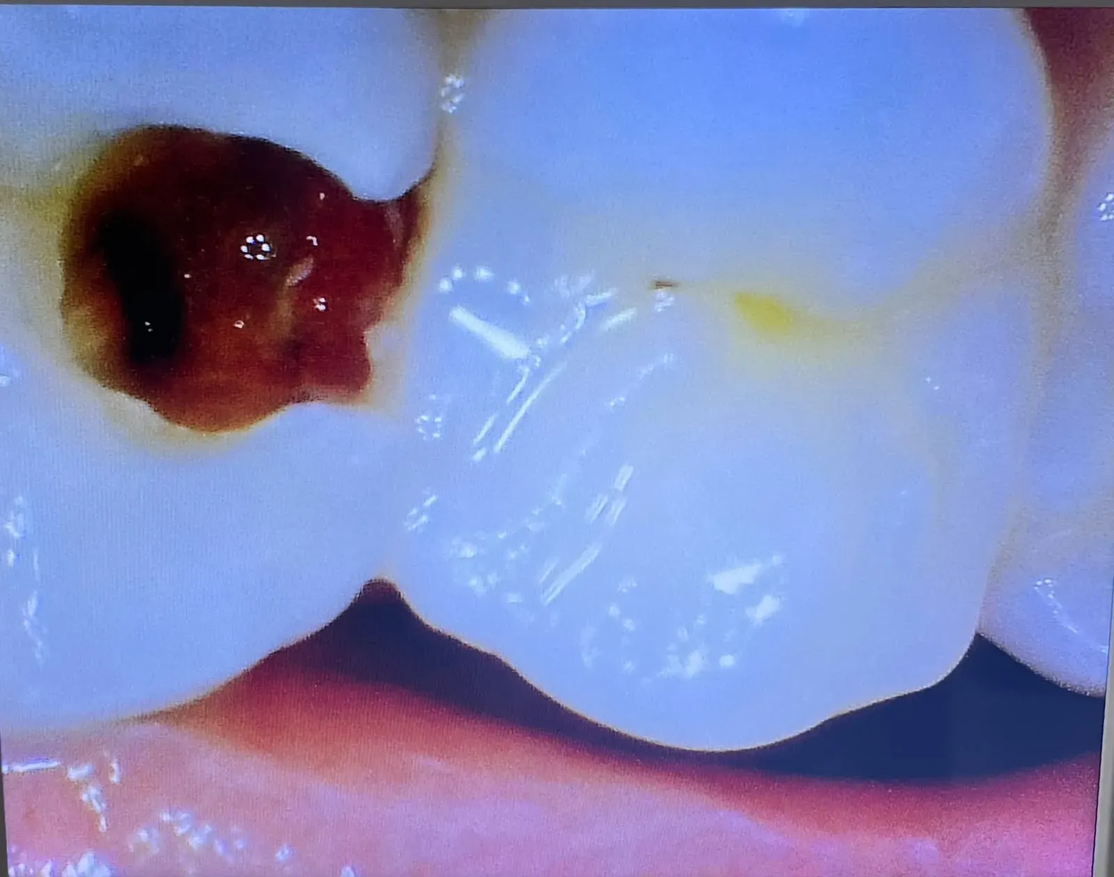 Magnified intraoral camera image of a deep carious lesion on a molar