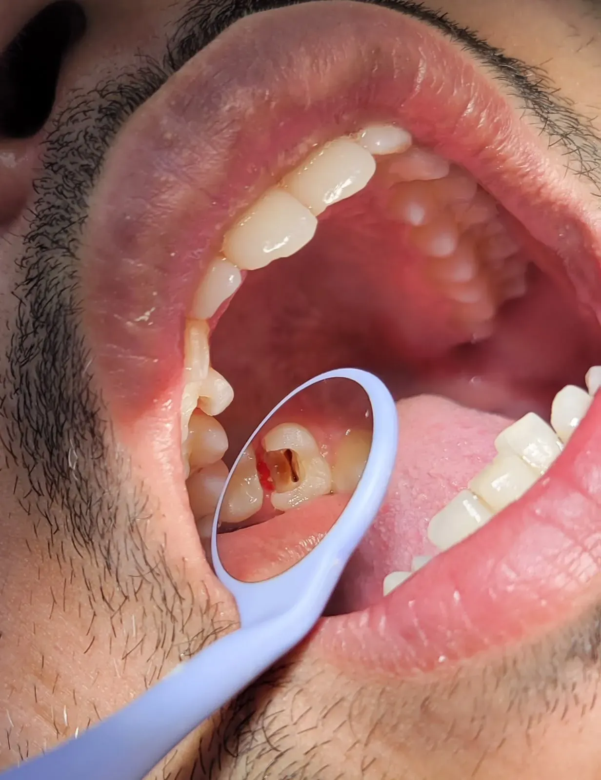 Mirror view of the upper arch showing the affected molar