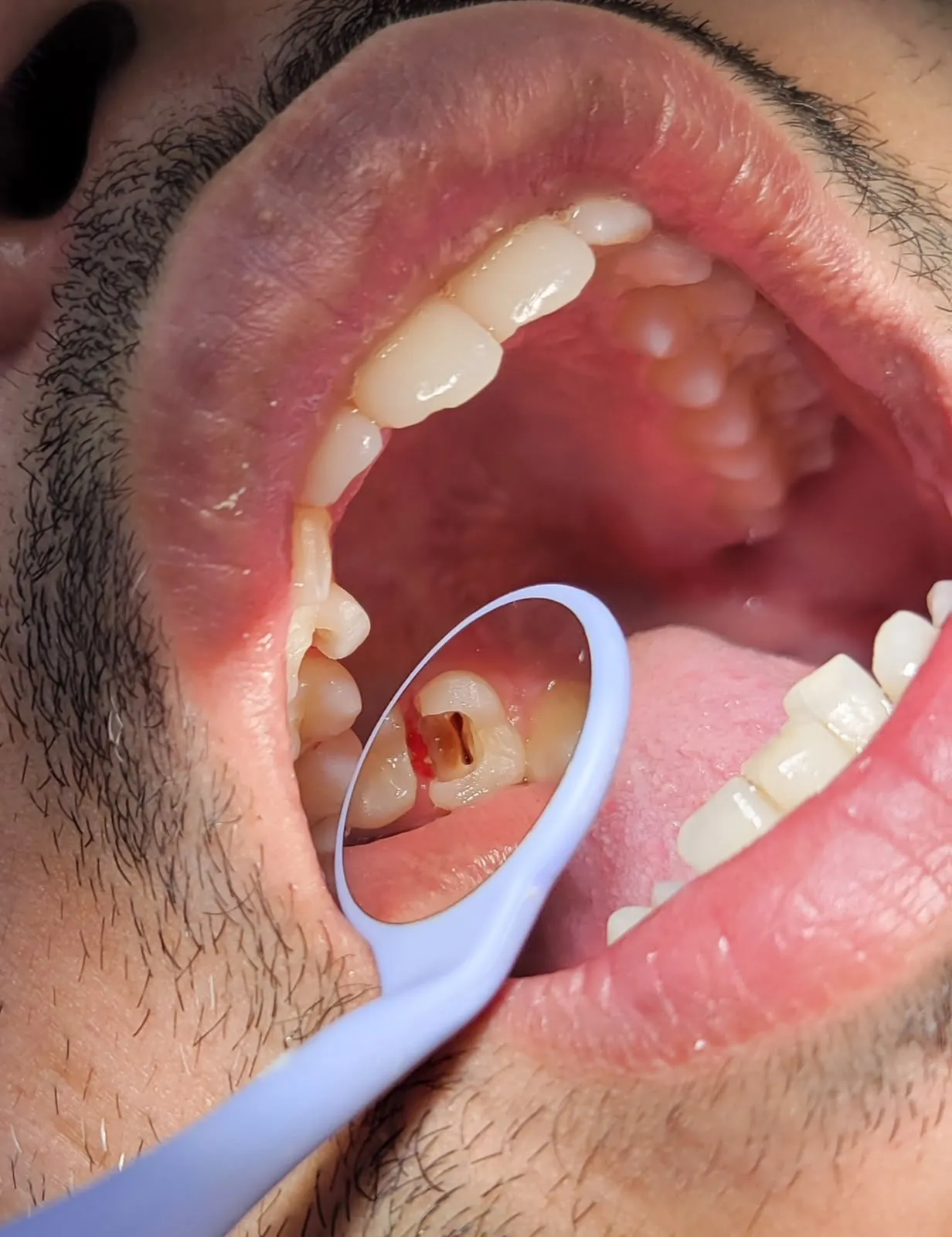 Mirror view of the upper arch showing the affected molar