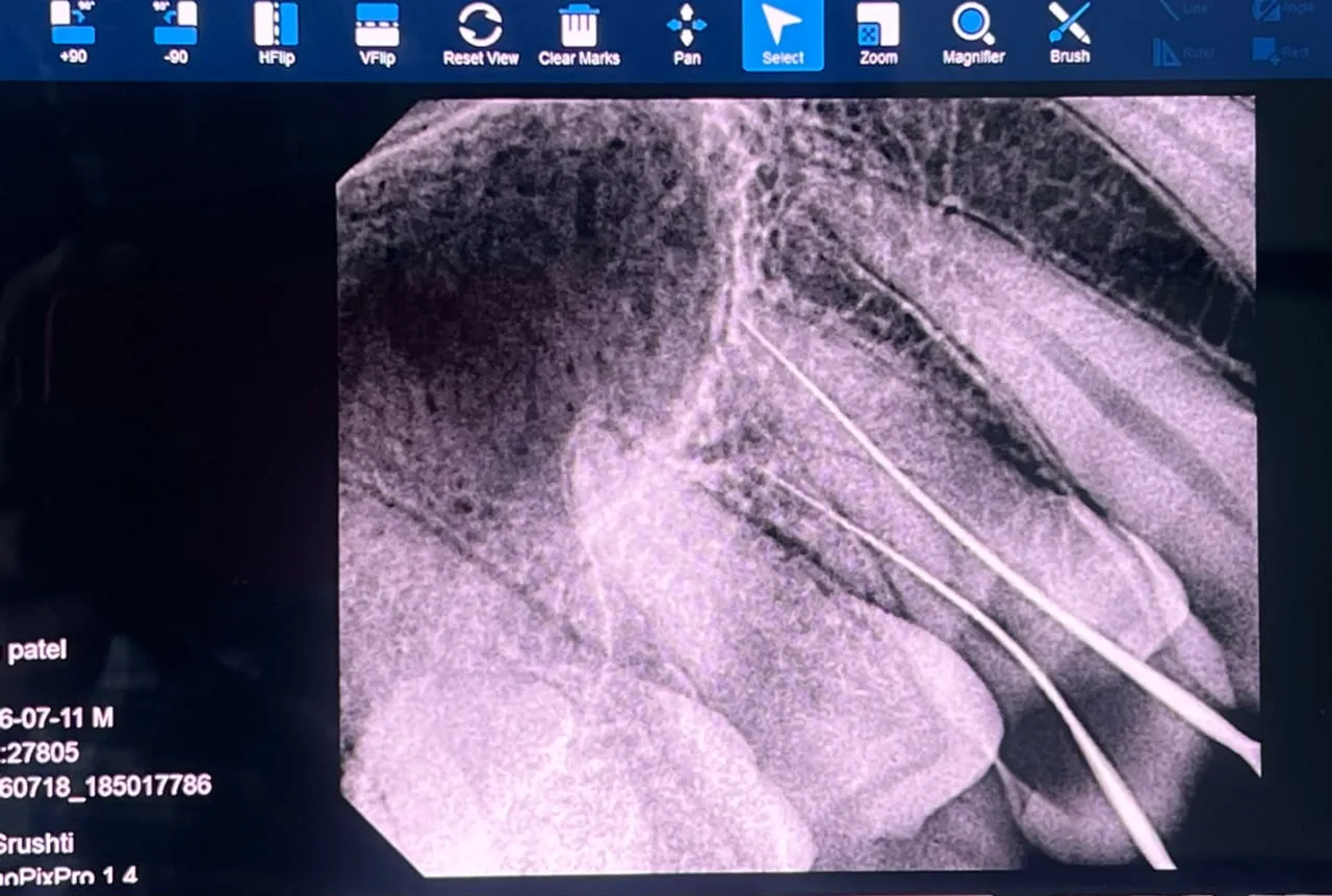 Working-length radiograph with endodontic files placed in the root canals