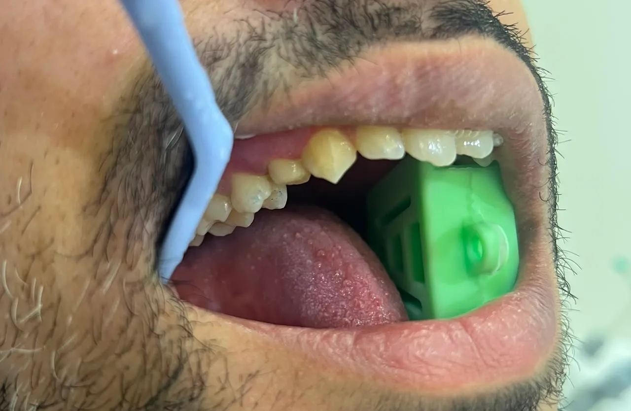 The tooth isolated with a bite block in place during treatment