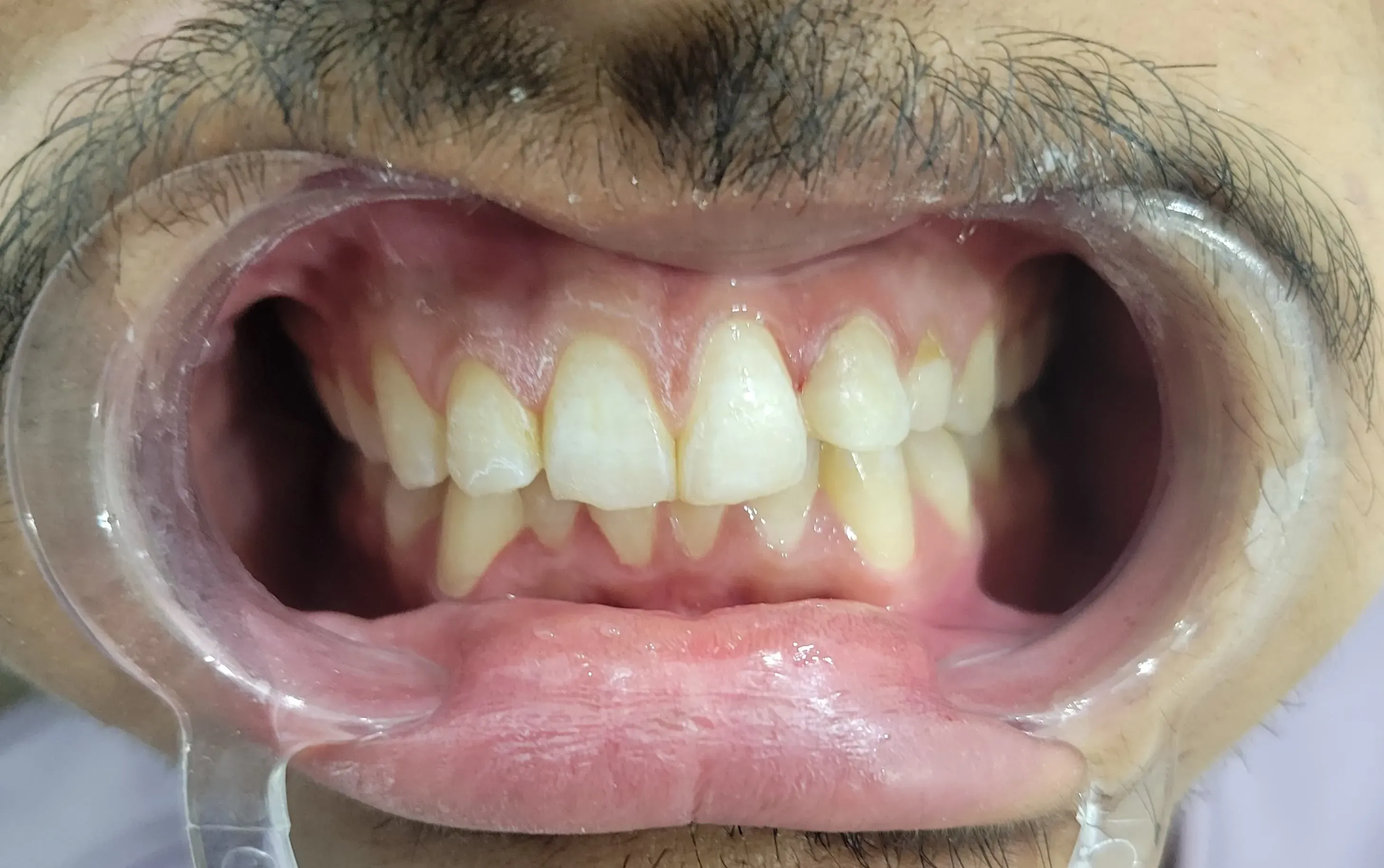 Natural tooth restoration with shade-matched composite filling sealing the cavity seamlessly