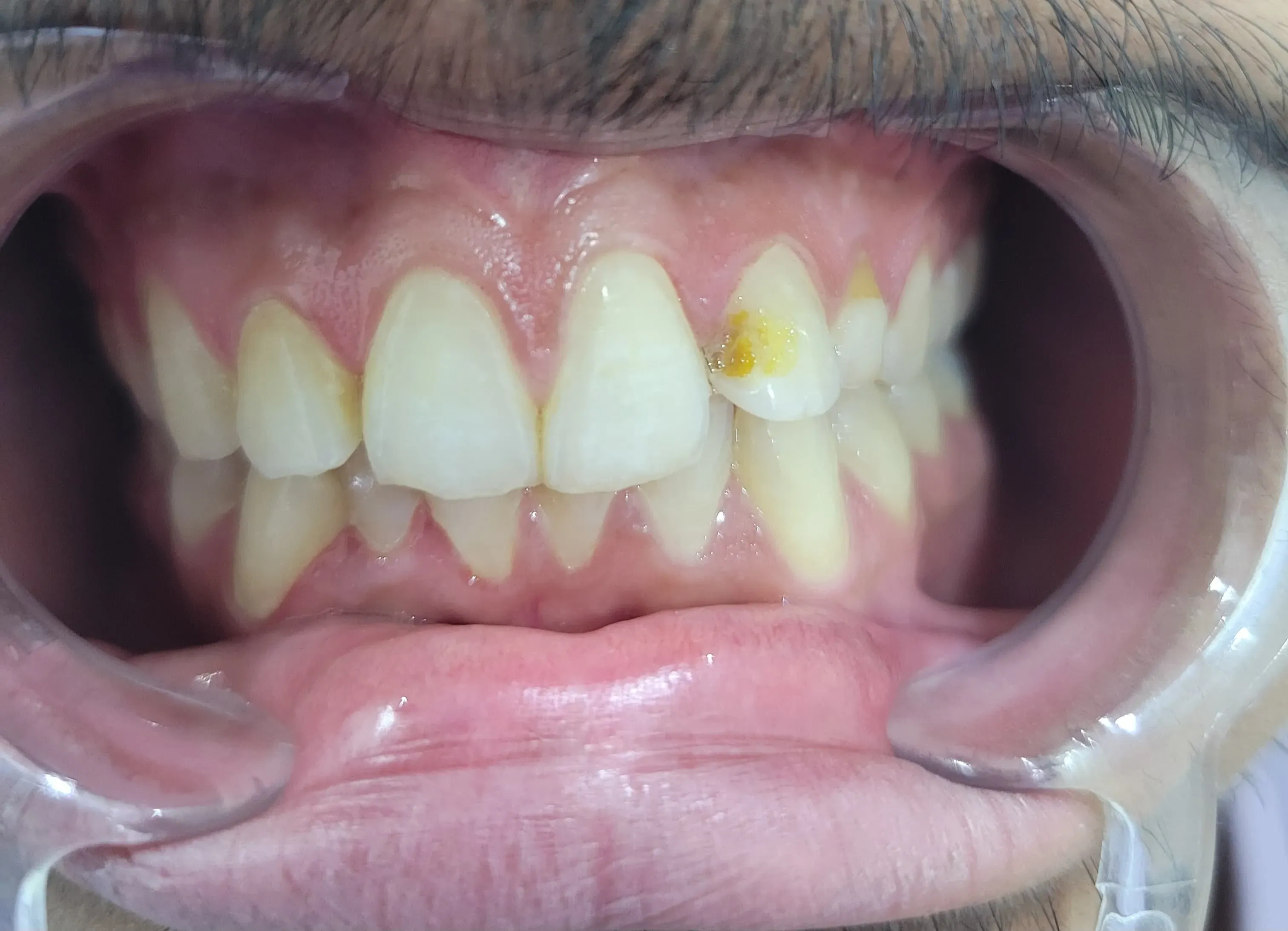 Visible yellow carious lesion and decay defect on upper canine tooth before composite filling