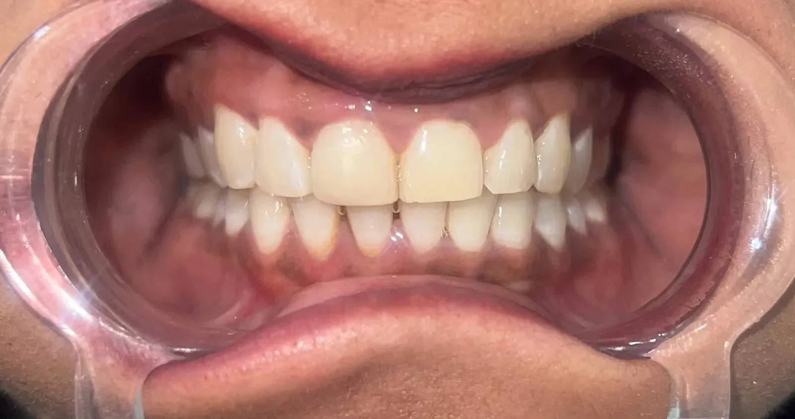 Seamless tooth-coloured composite bonding restoration for fractured central incisor by Dr. Srushti Patel in Kudasan, Gandhinagar