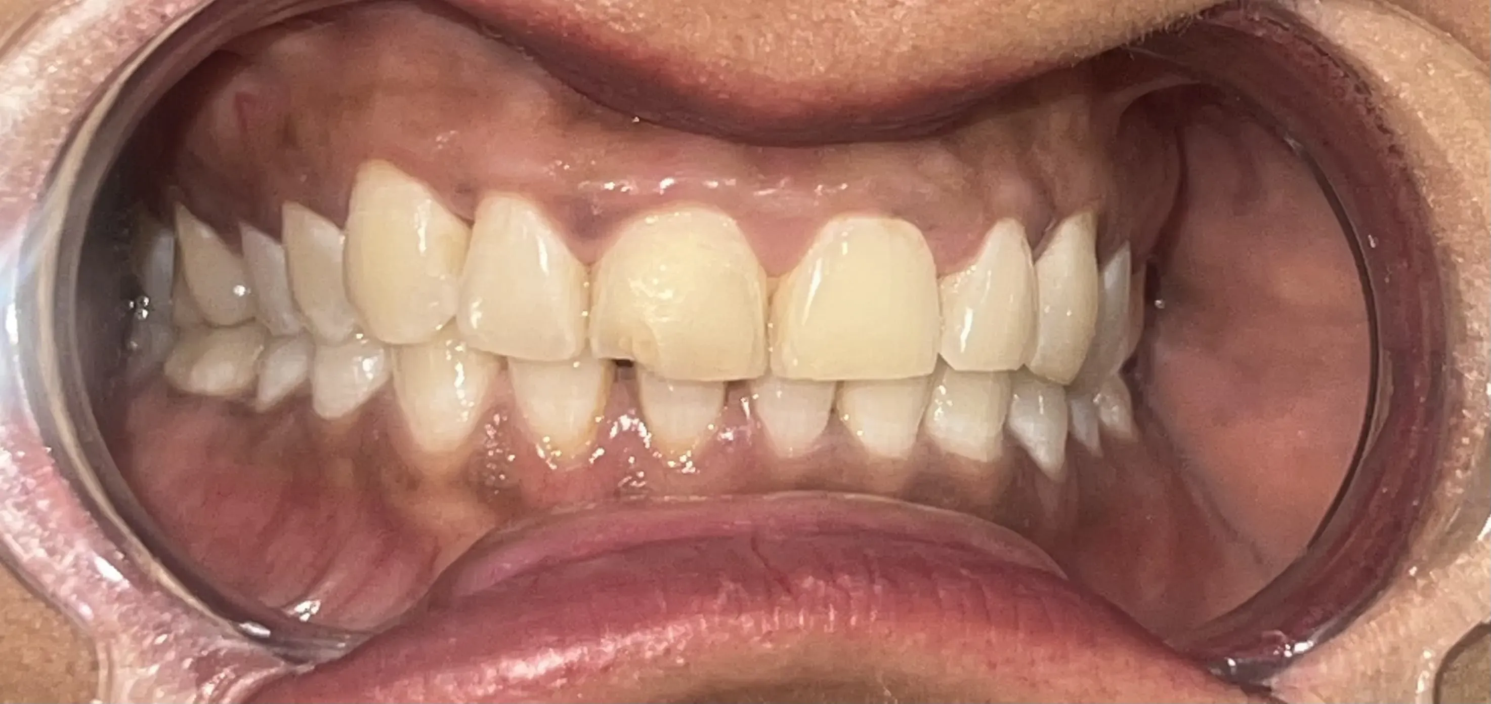 Fractured upper central incisor tooth with broken enamel edge before aesthetic composite bonding at Srushti's Dental House Gandhinagar