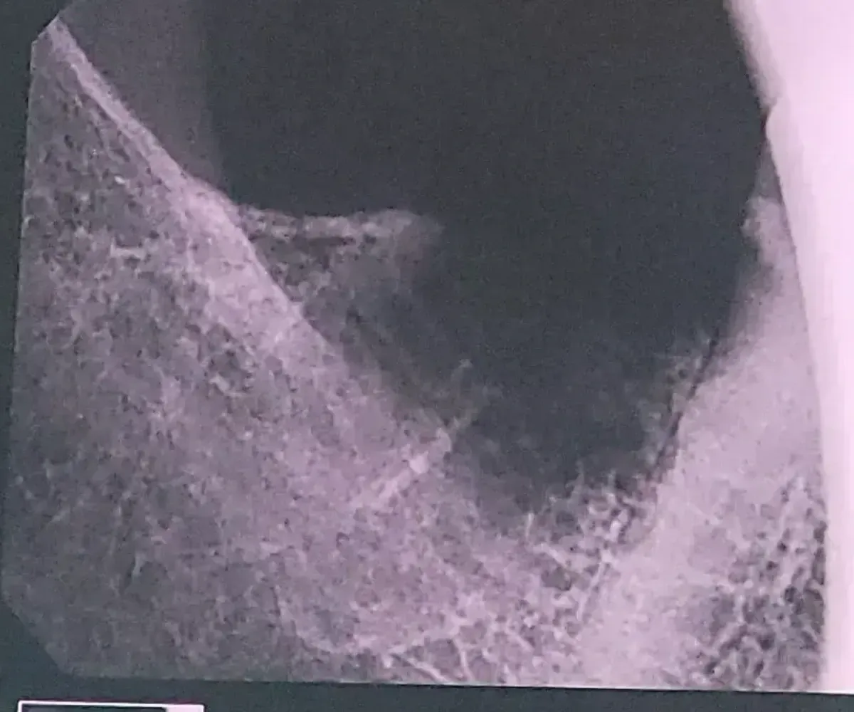 Post-operative digital radiograph confirming complete extraction of broken root piece with bone preservation
