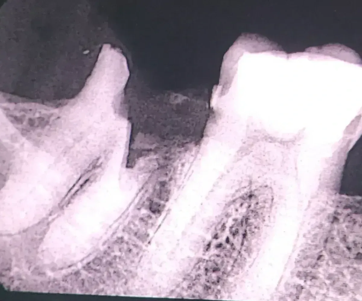 Digital RVG X-ray radiograph showing broken tooth root fragment embedded in alveolar bone