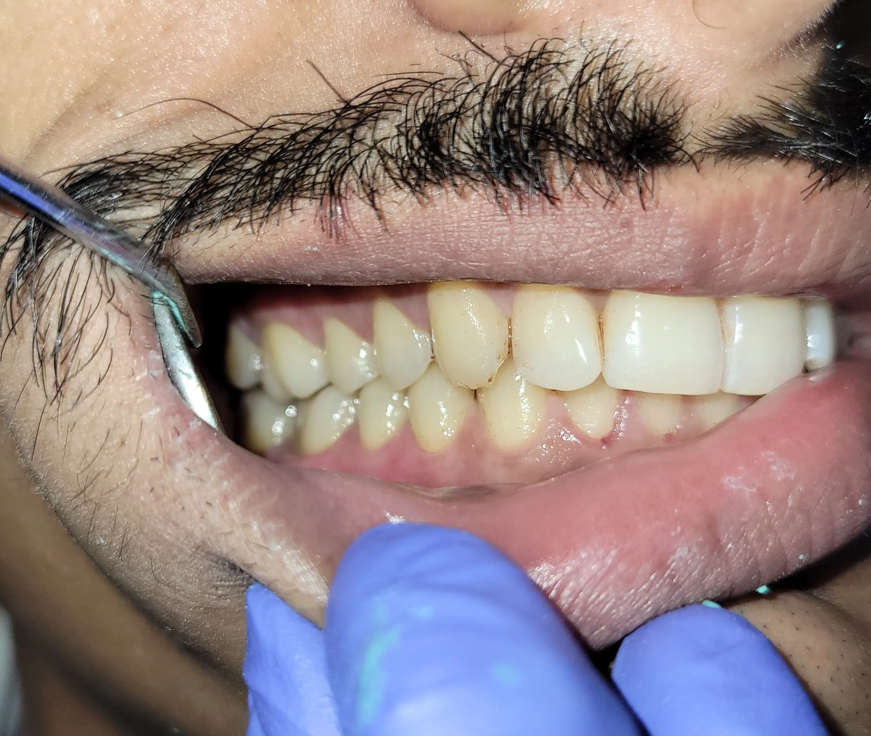 Healthy teeth and polished enamel margins after routine dental scaling in Kudasan Gandhinagar clinic