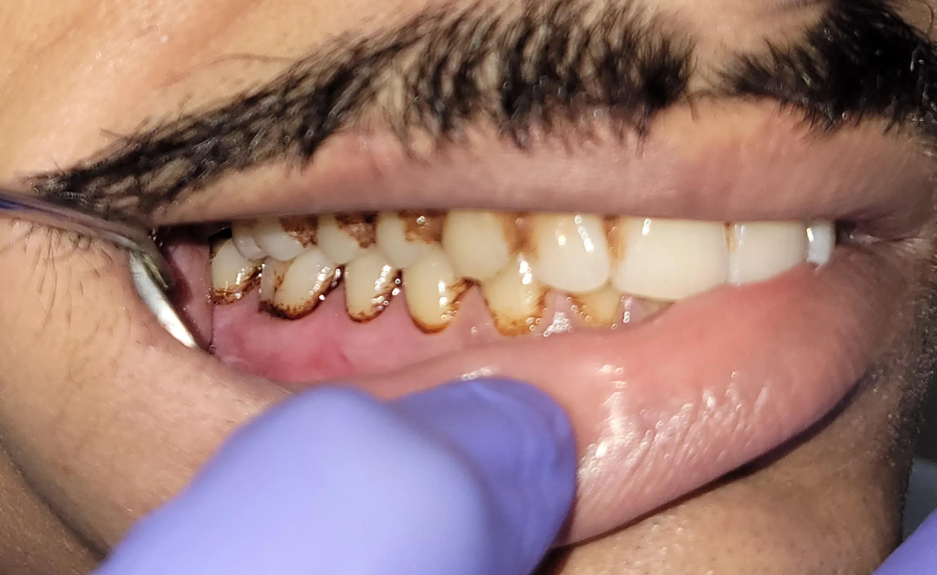 Plaque accumulation and dark calculus along lower front teeth gum line prior to dental cleaning
