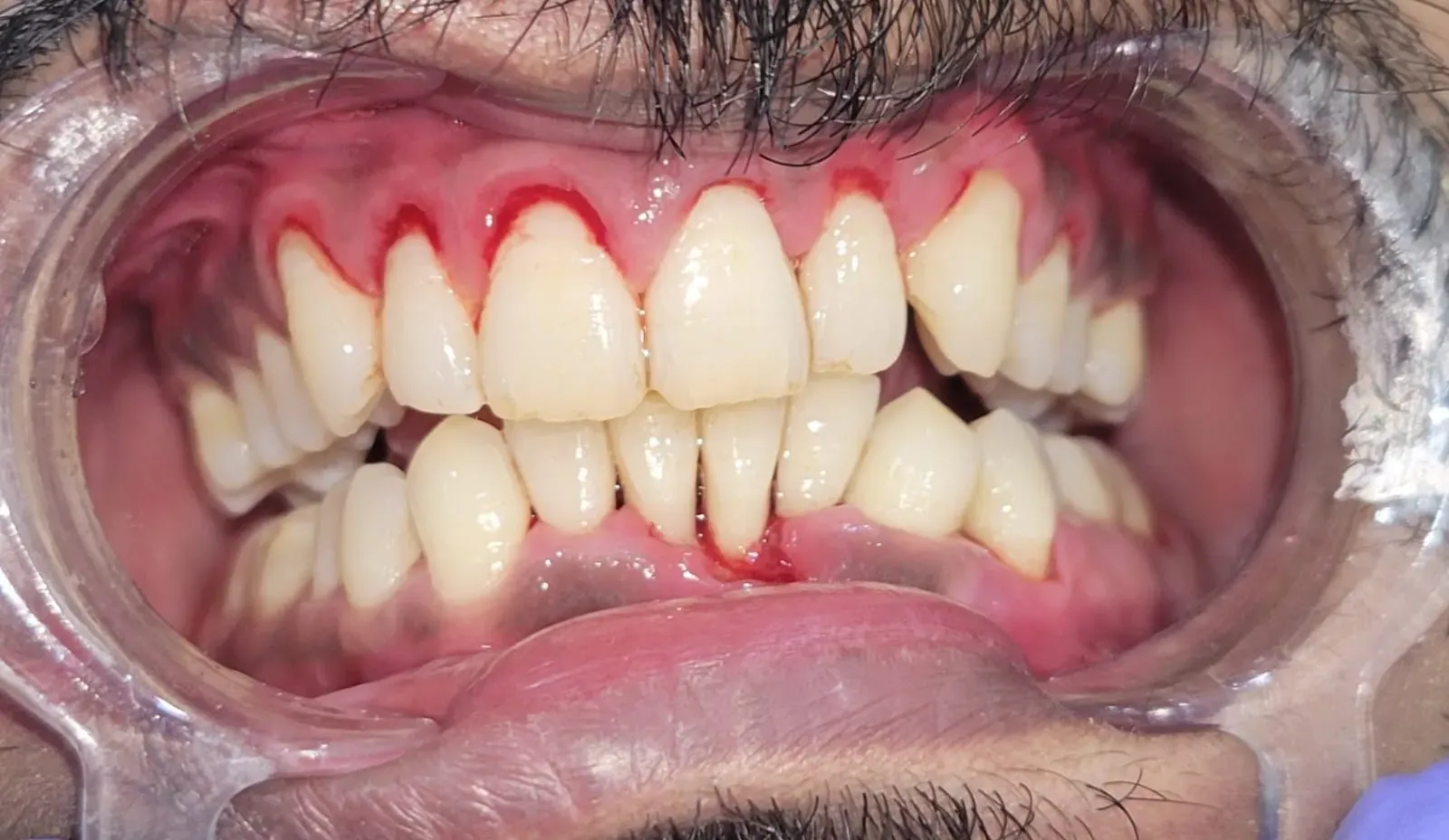 Clean, stain-free teeth and healthy pink gums following ultrasonic scaling and polishing at Srushti's Dental House