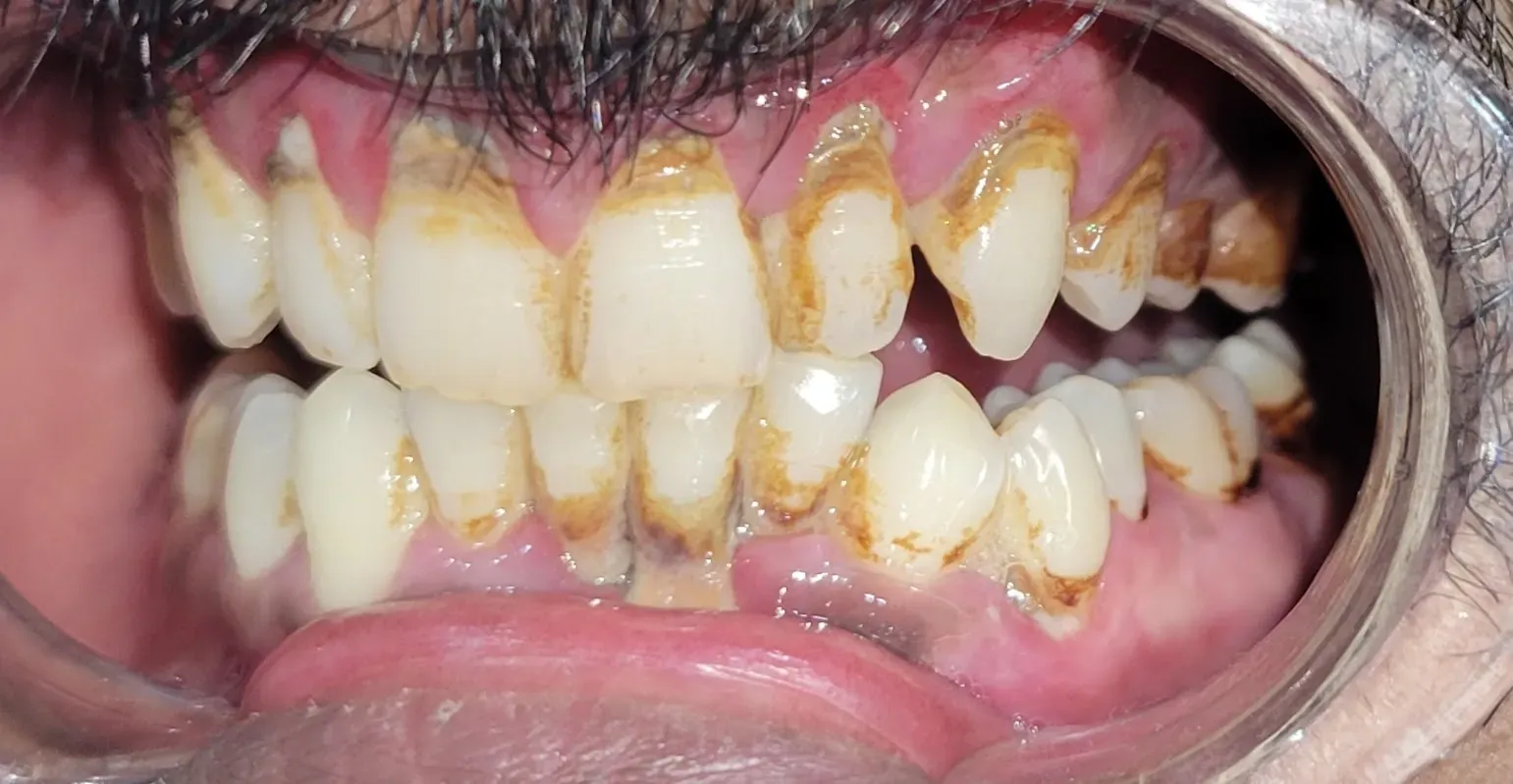 Heavy subgingival tartar, dark calculus and tobacco stains on lower and upper teeth before deep scaling treatment